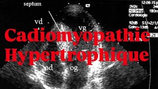 🫀CARDIOMYOPATHIE HYPERTROPHIQUE [upl. by Haldis]