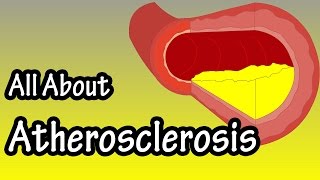 Atherosclerossis Explained  What Is Atherosclerosis  What Is Artery Plaque [upl. by Auqinet]