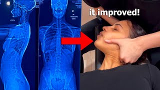 ASMR Chiropractor Adjusts my Scoliosis with Neck and Back Cracks [upl. by Pike]