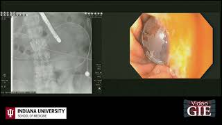 Endoscopic management of acute buried bumper syndrome [upl. by Wylma589]