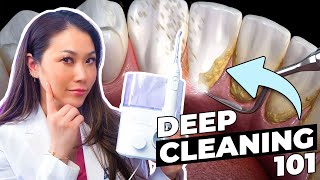 What is a DEEP TEETH CLEANING and WHY do you need one [upl. by Inatirb]