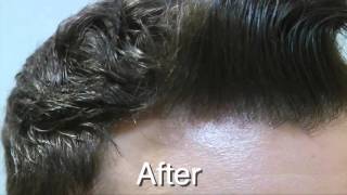 Norwood 3  3300 Graft FUT Hair Transplant  SHI Toronto  4147477873 [upl. by Keraj]