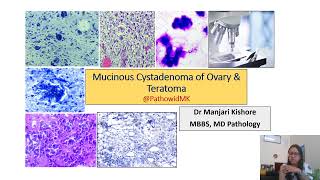 mucinous cystadenoma ovary amp teratoma ovary [upl. by Ennaj443]