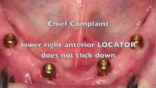 NEW Locator Dental Implant Attachments  Workshop Tips [upl. by Huppert]