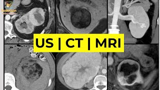 Imaging of Renal Masses ALL YOU NEED TO KNOW  Dr Daniel J Kowal RadiologistHQ [upl. by Janey]