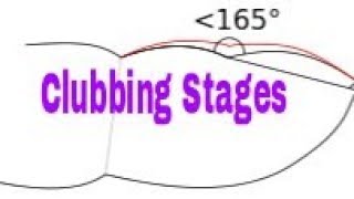 Stages of Clubbing [upl. by Knitter991]