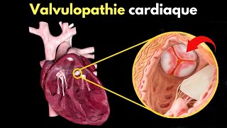 Comment se produit la valvulopathie cardiaque  Symptômes diagnostic et traitement [upl. by Moe652]