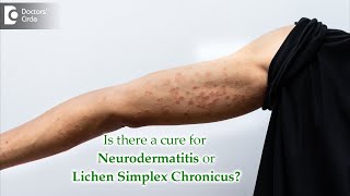 What is Neurodermatitis Causes Symptoms Diagnosis Treatment  Dr Aruna Prasad [upl. by Jaela]