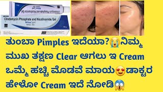 Nilac Cream Review in kannadaUsesside effectssafety Advice acneremoval pimplefree skincare [upl. by Swanson]