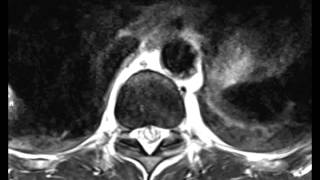 Epidural Hematoma with Spinal Cord Puncture Wound [upl. by Efal882]