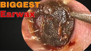 BIGGEST Earwax Difficult Removal EP 10  Doctor Anh [upl. by Nylle]