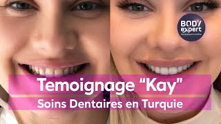 SOINS DENTAIRES  🦷 Témoignage de Kay  16 facettes dentaires Emax  BODYEXPERT [upl. by Zela576]