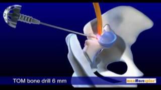 DB 115 Endoskopische Bandscheibenoperation  PAL 169  DB 115 Endoscopic Disc surgery  PAL 169 [upl. by Seigel762]