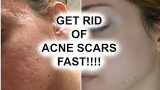 HOW TO GET RID OF ACNE SCARS  Pershii [upl. by Bedwell250]