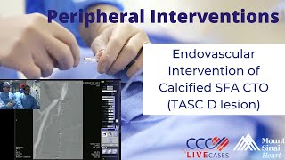 Endovascular Intervention of Calcified SFA CTO TASC D lesion  December 18 2013 Live Case Video [upl. by Annamarie]