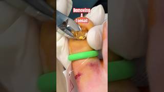 How to remove a Toenail 🤣 NOT MEDICAL ADVICE [upl. by Penrod383]