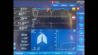 Endinspiratory Occlusion Maneuver and Pmus [upl. by Donnell]