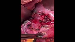 Presacral Pelvic Tumor Advancing in the IschioRectal Space [upl. by Farika]