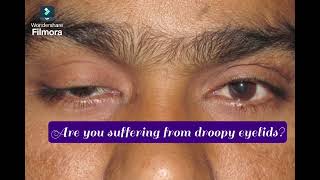 Are you suffering from droopy eyelidsDon’t hesitate to see your Oculoplasty Surgeon [upl. by Ayirp629]