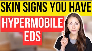 Unlocking The Secrets 12 Surprising Skin Signs Of Hypermobile EhlersDanlos Syndrome [upl. by Gladis947]