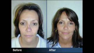 Expert New York City Facial Plastic Surgeon Dr Sam Rizk  FaceliftNecklift Before and After Photos [upl. by Oecam]