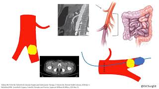 Acute Limb Ischemia [upl. by Ingar]