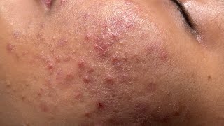 Blackheads amp Whiteheads Removal New 2024  Acne Treatment With Bo Nguyễn Spa 003 [upl. by Kiker]