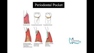 PERIODONTAL POCKET TERMINOLOGIES CLASSIFICATION FEATURES SITE SPECIFICITY HEALING LESION [upl. by Ester]