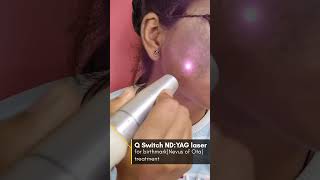 Birthmark removal Nevus of Ota By Q switch NdYAG laser ✅ [upl. by Ap]