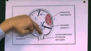 Tentorial herniation [upl. by Au]