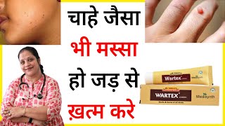 मस्से का इलाज   Warts ka ilaj  Masse ka ilaj  Wartex cream  Warts homeopathic medicine [upl. by Eceirtal]