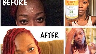 Burts Bees Natural Acne Solutions Review before and after [upl. by Adnirual]