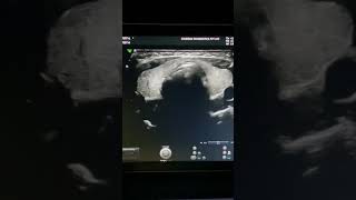 What Does a NORMAL Thyroid Ultrasound Look Like thyroid thyroidproblems drvandanaa [upl. by Anade]