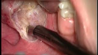 Коблатор  Coblation Tonsillectomy  Plasma Surgical System [upl. by Atteuqihc]