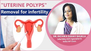 Uterine Polyps Symptoms Treatment amp Pregnancy  Endometrial Polyp  Infertility Treatment [upl. by Ahtiekal]