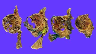 Well encapsulated pancreatic mass  Typical features of solid pseudopapillary neoplasms SPN [upl. by Nylareg]