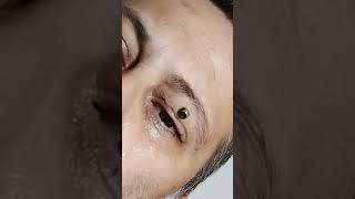 Botfly Maggot Removal spa doctor satisfying pimple removal [upl. by Emeric]