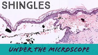 Shingles under the microscope VZV Varicella Zoster Herpes pathology dermpath dermatopathology [upl. by Jepum917]