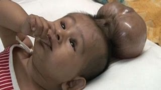 Baby Born With Two Heads  Extraordinary Birth [upl. by Ennayehc]