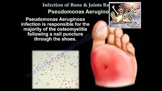 Infection of Bones amp Joints A Review  Everything You Need To Know  Dr Nabil Ebraheim [upl. by Chae567]