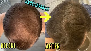 HE REGREW HIS BALD HEAD USING THESE 3 SIMPLE HAIR LOSS TREATMENTS [upl. by Atiuqaj746]