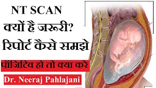 NT Scan in Hindi  प्रेगनेंसी के 13 हफ्ते का सबसे जरूरी टेस्ट NT Test [upl. by Reider]