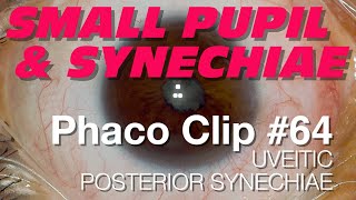 Phaco Clip 64  Uveitic Posterior Synechiae [upl. by Rabassa]