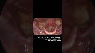 Vocal Stroboscopy Video [upl. by Placidia713]