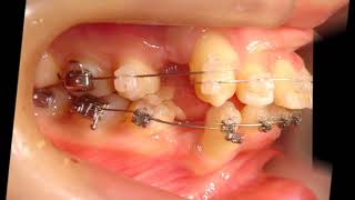 Orthodontic libraryHK Dental crowding Protruding teeth Chart No4730 [upl. by Aniham]