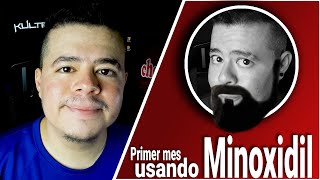 PRIMER MES USANDO MINOXIDIL [upl. by Crooks]