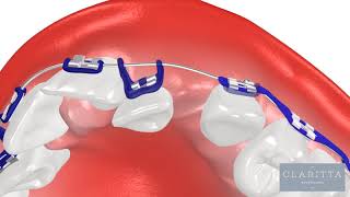 Oque é Ortodontia Como funciona um Aparelho Ortodôntico ortodontia invisalign clinicajin [upl. by Annelg]