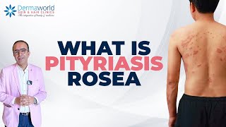 Skin Rash Pityriasis Rosea Hai  Symptoms Aur Treatment Explained  dermaworldskinclinics [upl. by Airdnaxela742]