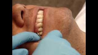 Temporary Anchorage Device TAD Removal with Dr Jaime Rojas Orthodontist London ON [upl. by Aholah]