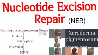 DNA Repair mechanism  Nucleotide Excision Repair II Xeroderma pigmentosum cause and features [upl. by Dorcas]